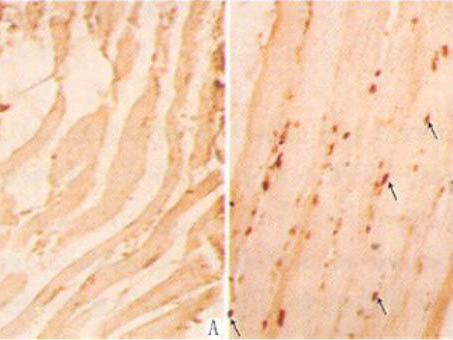 肌營(yíng)養(yǎng)不良癥受累肌肉的細(xì)胞凋亡