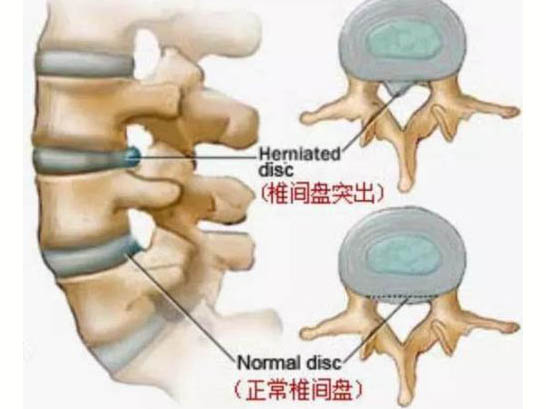 無(wú)菌性炎癥致痛學(xué)說(shuō)與頸肩腰腿痛的發(fā)病機(jī)制